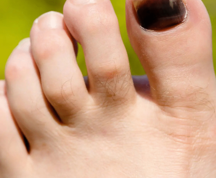 Why Has My Toe Nail Gone Black? 8 Shocking Causes & Fixes